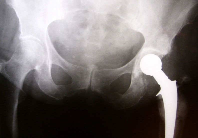 X-ray image of hip implant